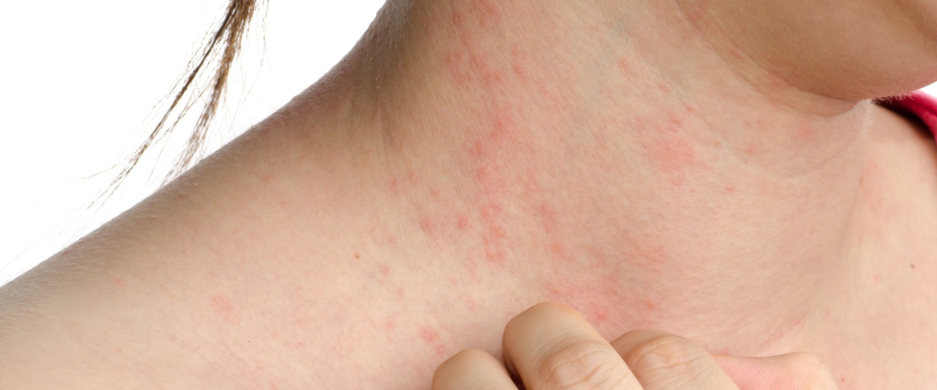 Understanding Allergic Reactions: What You Need to Know