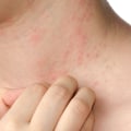 Understanding Allergic Reactions: What You Need to Know