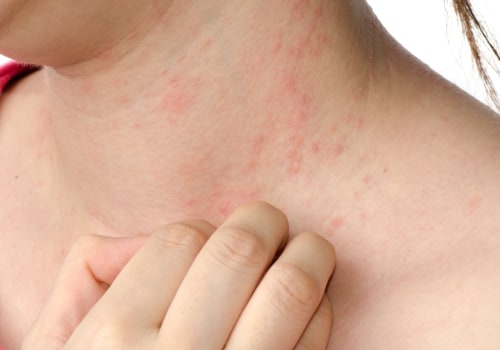 Understanding Allergic Reactions: What You Need to Know